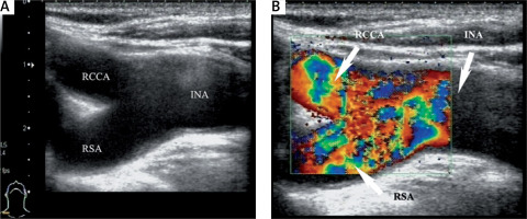 https://www.archivesofmedicalscience.com/f/fulltexts/114895/AMS-20-3-114895-g001_min.jpg