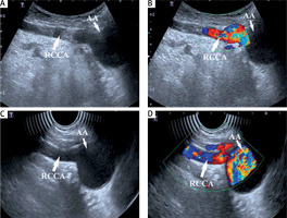 https://www.archivesofmedicalscience.com/f/fulltexts/114895/AMS-20-3-114895-g004_min.jpg