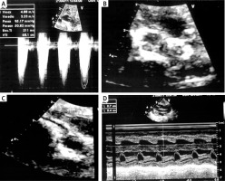 https://www.archivesofmedicalscience.com/f/fulltexts/194435/AMS-20-5-194435-g001_min.jpg