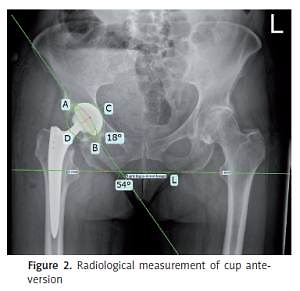 Identification of risk factors for treatment failure of closed reduction  and abduction bracing after first-time total hip arthroplasty dislocation